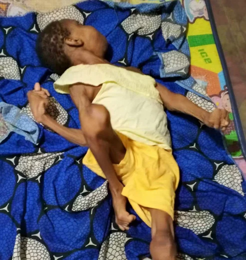 Niño desnutrido durmiendo en una colcha azul